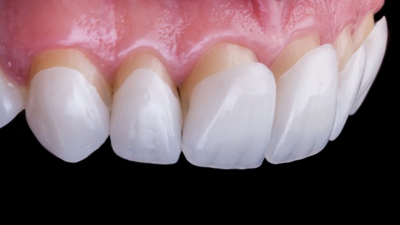 VENEERS
